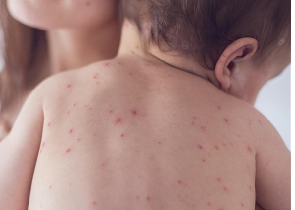 Campak Bisa Berujung Fatal, IDAI Imbau Orang Tua Lengkapi Imunisasi Anak