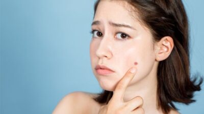 Jangan Abaikan! Tahi Lalat Membesar Bisa Jadi Tanda Melanoma